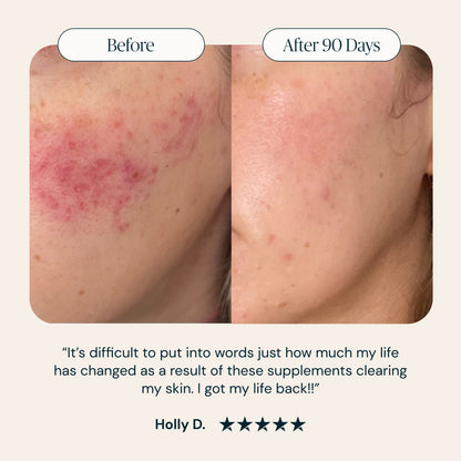 THE ACNE SUPPLEMENT